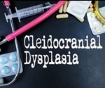 What is Cleidocranial Dysplasia?