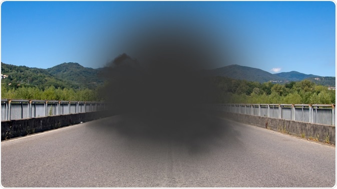 macular degeneration