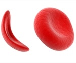 What is Sickle Cell Trait (SCT)?