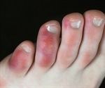 COVID-19 symptoms in the feet
