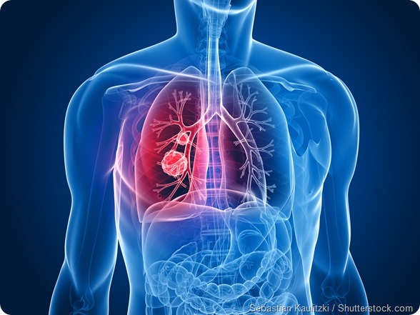 Lung cancer