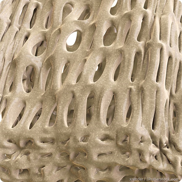 Osteoporosis illustration