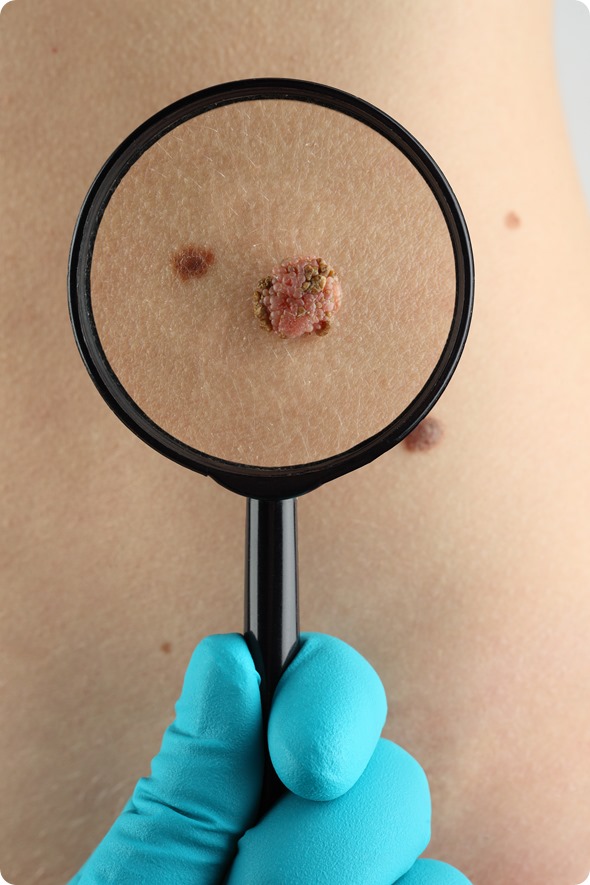 Skin tag removal
