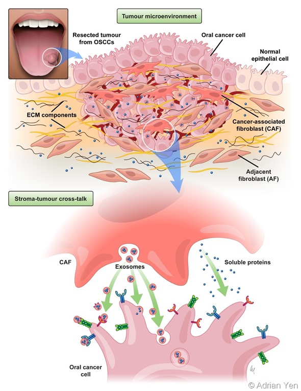 Tongue cancer diagram