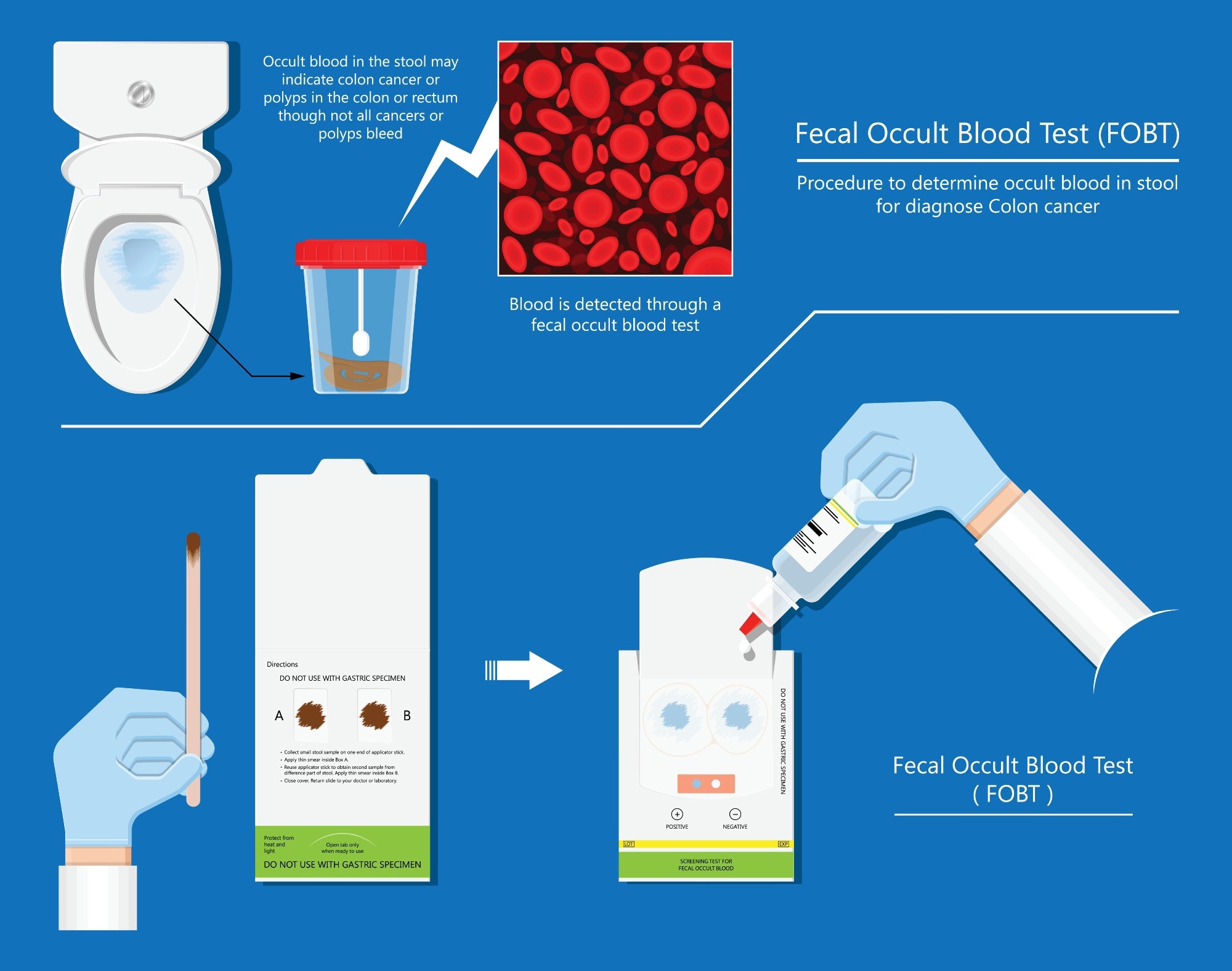 Fecal occult blood test FOBT lab stool sample, bleeding screen, risk examination, collect container, Guaiac diagnosis, sign, hemoccult smear, FIT diagnostic. Image Credit: Pepermpron / Shutterstock