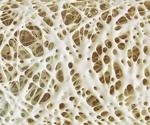 Osteoporosis and Hearing Loss