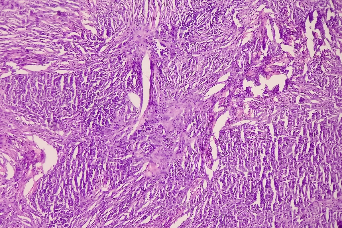 The majority of myofibromas are sporadic and occur infrequently. Image Credit: Babul Hosen/Shutterstock