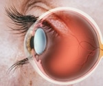 What is Optic Nerve Hypoplasia?