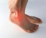 Osteomyelitis Treatment