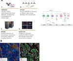Uncovering novel therapeutic targets in immune checkpoint inhibitor resistance through spatial proteomics in metastatic tumor microenvironments
