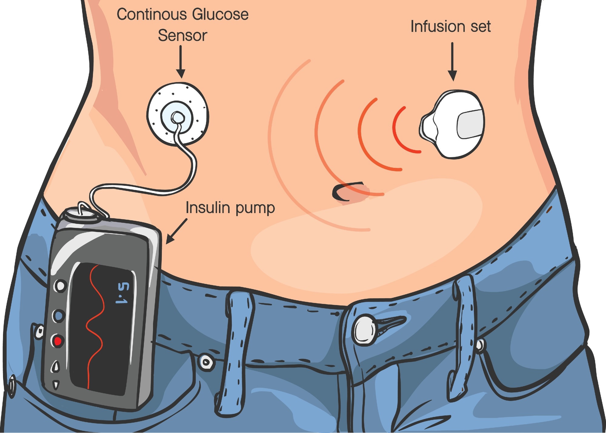 Illustration showing how an insulin pump works: a continuous glucose sensor attached to the abdomen, an infusion set delivering insulin, and the pump device clipped to the waistband.