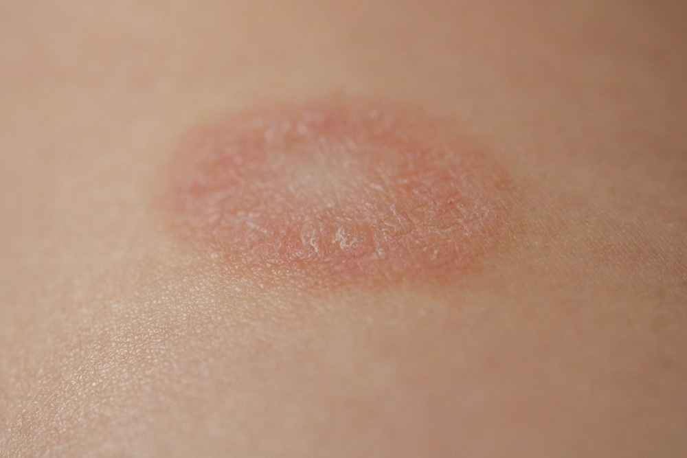Close-up image of a Pityriasis Rosea rash, showing a single, round, reddish-pink patch with a slightly raised, scaly border on the skin, commonly known as the