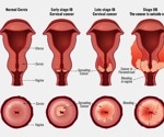 What is Cervical Cancer?