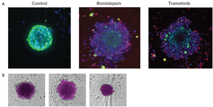 A. End-point analysis of fluorescent images was done using Custom Module Editor ImageXpress software. Images (maximum projection), and analysis masks shown. Multiple measurements were derived for cell scoring and organoid characterization. B. Automated monitoring and image analysis of 3D cancer microtissues was done using transmitted light images (10X) with AI-based image analysis In Carta software (analysis mask shown in purple).