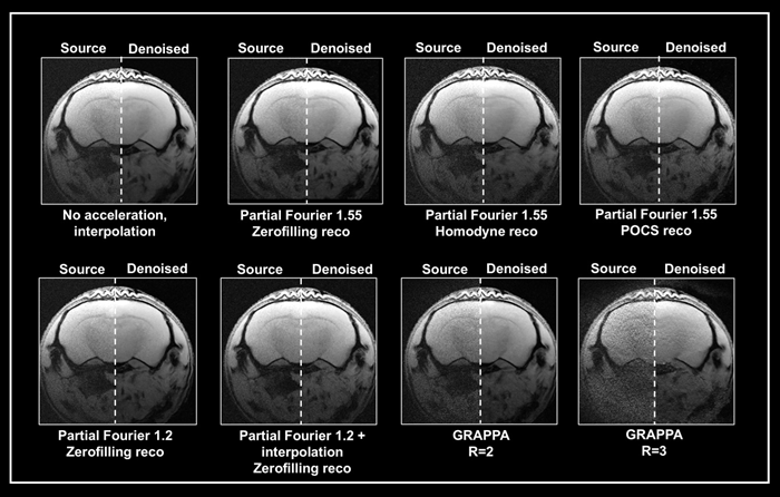 Denoising of accelerated brain data