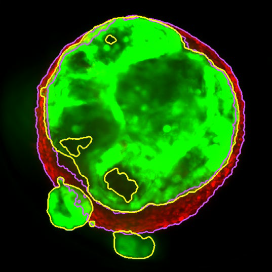 Z slice of the tumor microtissue treated with 0.05% DMSO - tumor (yellow region) and fibroblast (purple region) are recognized separately in 3D