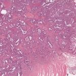 High quality ASTERAND® accredited human oncology tissues for drug discovery