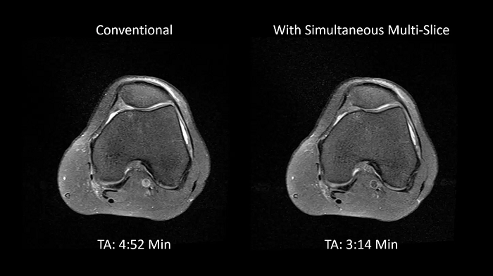 80 cm bore MAGNETOM Free.Max