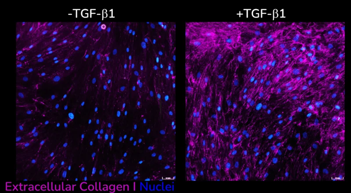 Extracellular collagen I deposition without (left) and with(right) following TGF-β1 stimulation of primary HLFs acquired using ImageXpress Confocal HT.ai imaging system, Scale bar: 50 µM