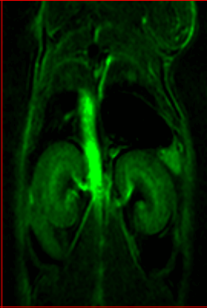 Signal enhancement maps generated by subtraction of the pre-contrast T1-weighted images from post contrast images using third party software VivoQuant.