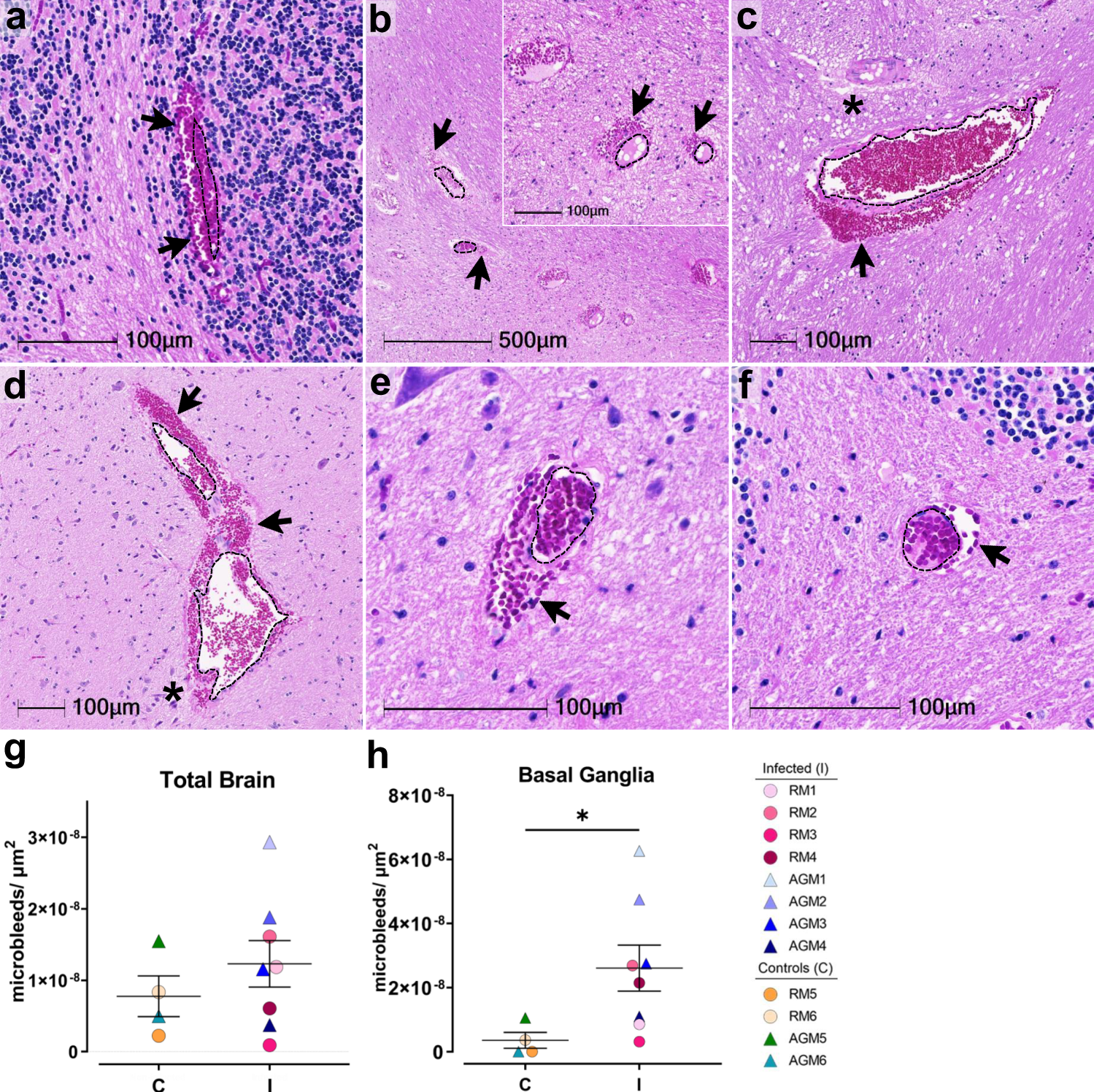 H&E examination of infected animals revealed microhemorrhages, as demonstrated in cerebellum (AGM1 a), brainstem (AGM2 b, AGM4 c), and basal ganglia (RM4 d), which tended to be larger and packed with red blood cells, as compared to non-infected controls, (RM6 brainstem e, AGM5 cerebellum f). Erythrocyte extravasation into the brain parenchyma is indicated by black arrows. Asterisks denote tissue injury around damaged blood vessels. A dotted line outlines the vessel lumen in each panel. H&E was performed and assessed twice on all brain regions. The number of microbleeds/mm2 was assessed in all brain regions (g) and found to be significantly greater in the basal ganglia (h, *p = 0.0263), where n = 4 biologically independent samples in the control group and n = 8 biologically independent samples in the infected group. Statistics were performed with a two-tailed Mann–Whitney U test. *p ≤ 0.05. Data are expressed as mean ± SEM. Source data are provided as a Source Data file. Abbreviations: C control, I infected, AGM African green monkey, RM Rhesus macaque. Scale bars = 100 µm except outset of b where scale bar = 500 µm.