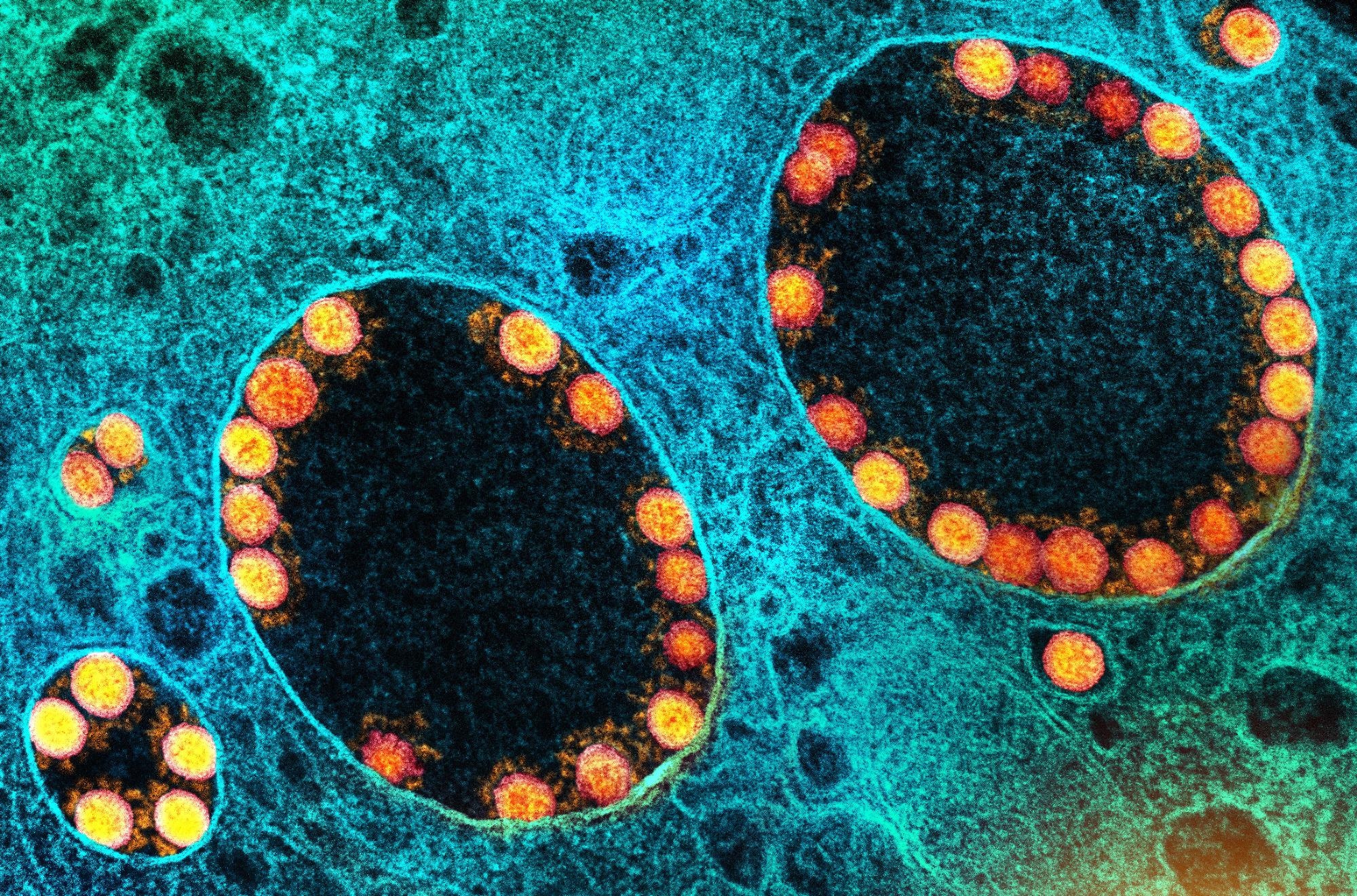 Study: Sequential Appearance and Isolation of a SARS-CoV-2 Recombinant between Two Major SARS-CoV-2 Variants in a Chronically Infected Immunocompromised Patient. Image Credit: NIAID