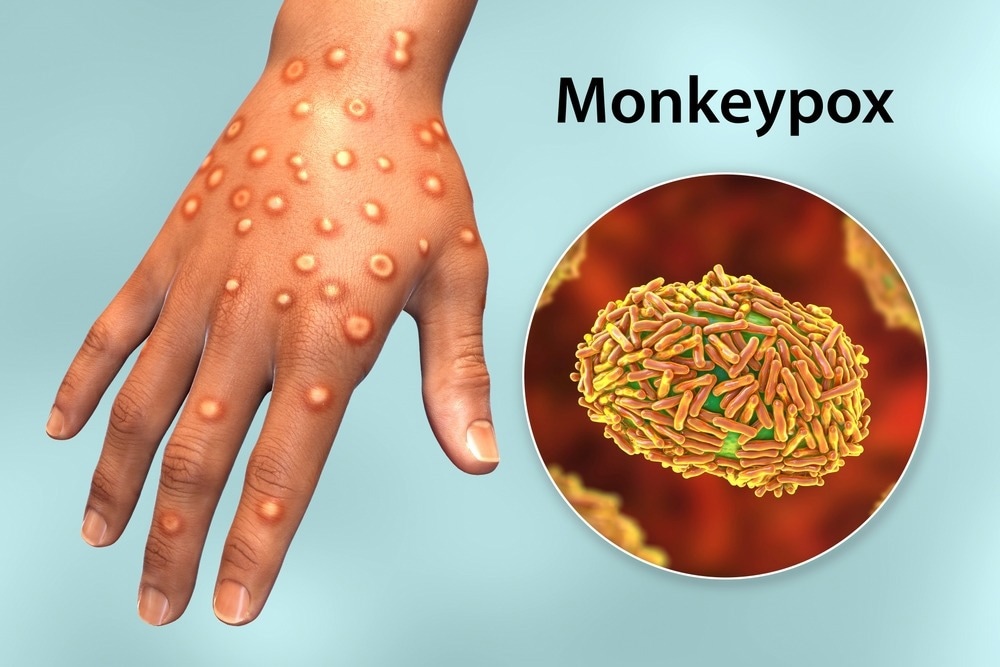 Study: Monkeypox numbers, treatment and prevention with two CDC experts. Image Credit: Kateryna Kon / Shutterstock.com