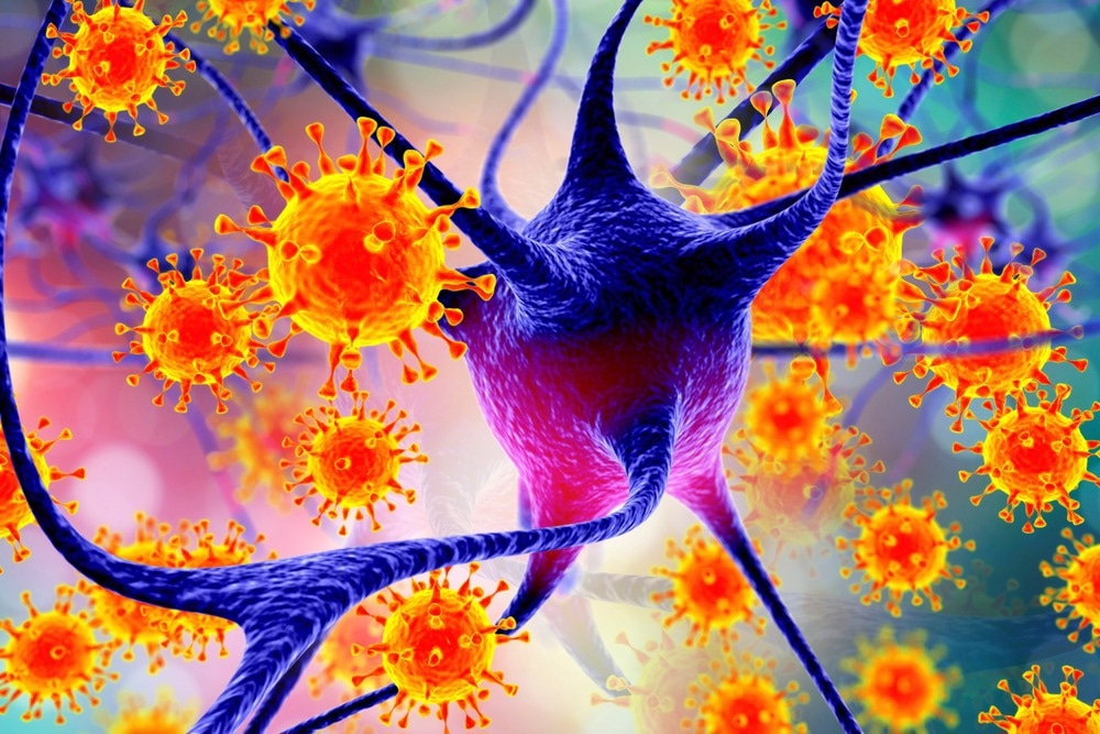 Study: Longitudinal analysis reveals high prevalence of Epstein-Barr virus associated with multiple sclerosis. Image Credit: Kateryna Kon / Shutterstock.com