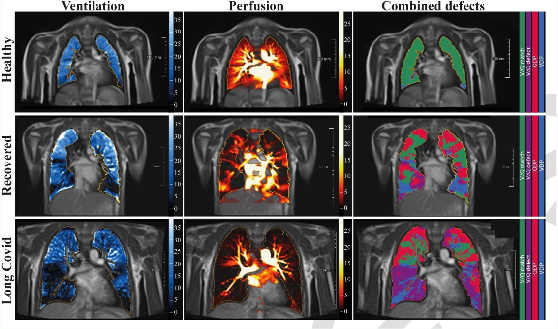 Free-breathing phase-resolved functional lung (PREFUL) low-field MRI at 0.55T with calculated parameters at an axial plane after automatic registration to a mid-expiration position and lung parenchyma segmentation. From left to right, representative color-coded images of functional show ventilation defects (VDP, blue), perfusion defects (QDP, red), ventilation/perfusion (V/Q match, green), ventilation/perfusion defects (V/Q defect, purple) in a healthy control (upper row, 7-year-old male), a participant recovered from COVID-19 (middle row, 10-year-old male) and a participant with long COVID (15-year-old male).