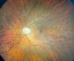 Association of self-reported chronic fatigue and retinal microcirculation in post-COVID-19 syndrome patients