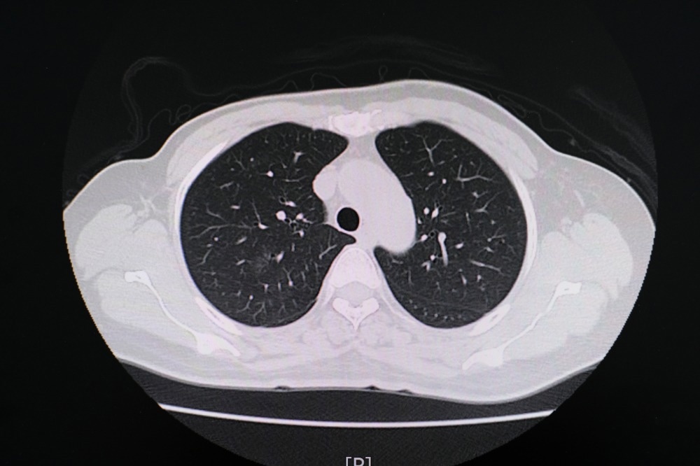Study: Chest CT Findings in Marijuana Smokers. Image Credit: PIJITRA PHOMKHAM / Shutterstock.com
