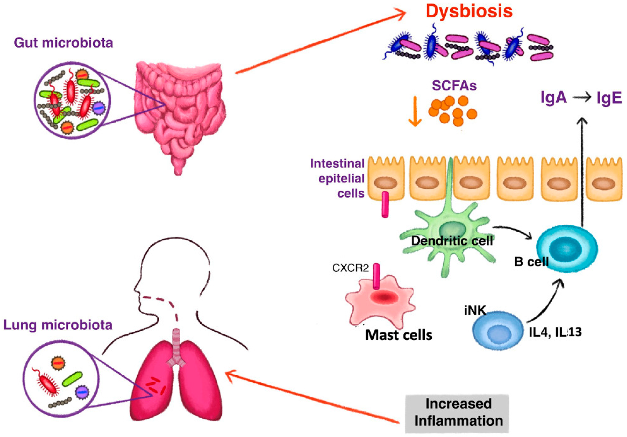 The mechanism of gut dysbiosis leading to the development of type 2 inflammation in asthma. Reduction of short chain fatty acids (SCFAs) induce a class switching of immunoglobulin (Ig) with an increase of fecal IgE acting on dendritic cells. Switching to IgE production is also stimulated by high levels of interleukin (IL) 4 and IL 13, produced by invariant natural killer (iNK) cells under dysbiosis stimuli. Dysbiosis influences the homing of mast cells to the intestine by the expression of CXCR2. Fewer intestinal mast cells and increased blood levels stimulate an inflammatory state observed in asthma.