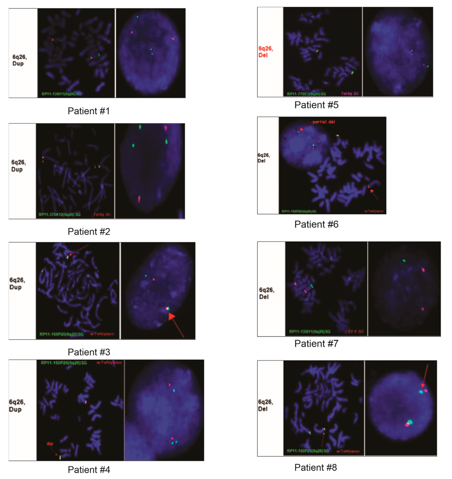 FISH images from eight of the nine patients demonstrating duplication or deletion within the 6q26 region.