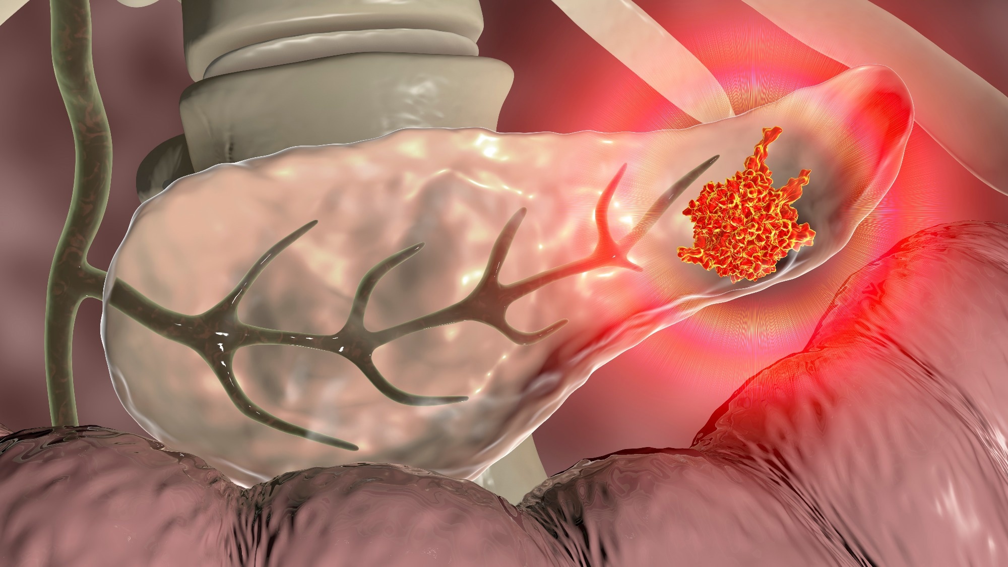 Study: Uridine-derived ribose fuels glucose-restricted pancreatic cancer. Image Credit: Kateryna Kon / Shutterstock