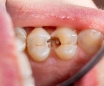 Fluoride and sealants win against youth dental caries, a robust review informs US health policy