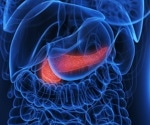 New study identifies key protein biomarkers for early detection of pancreatic cancer