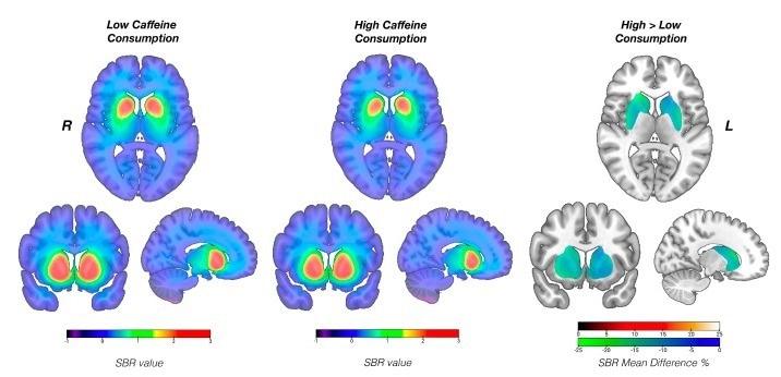 Chronic caffeine intake may impact brain chemistry in Parkinson