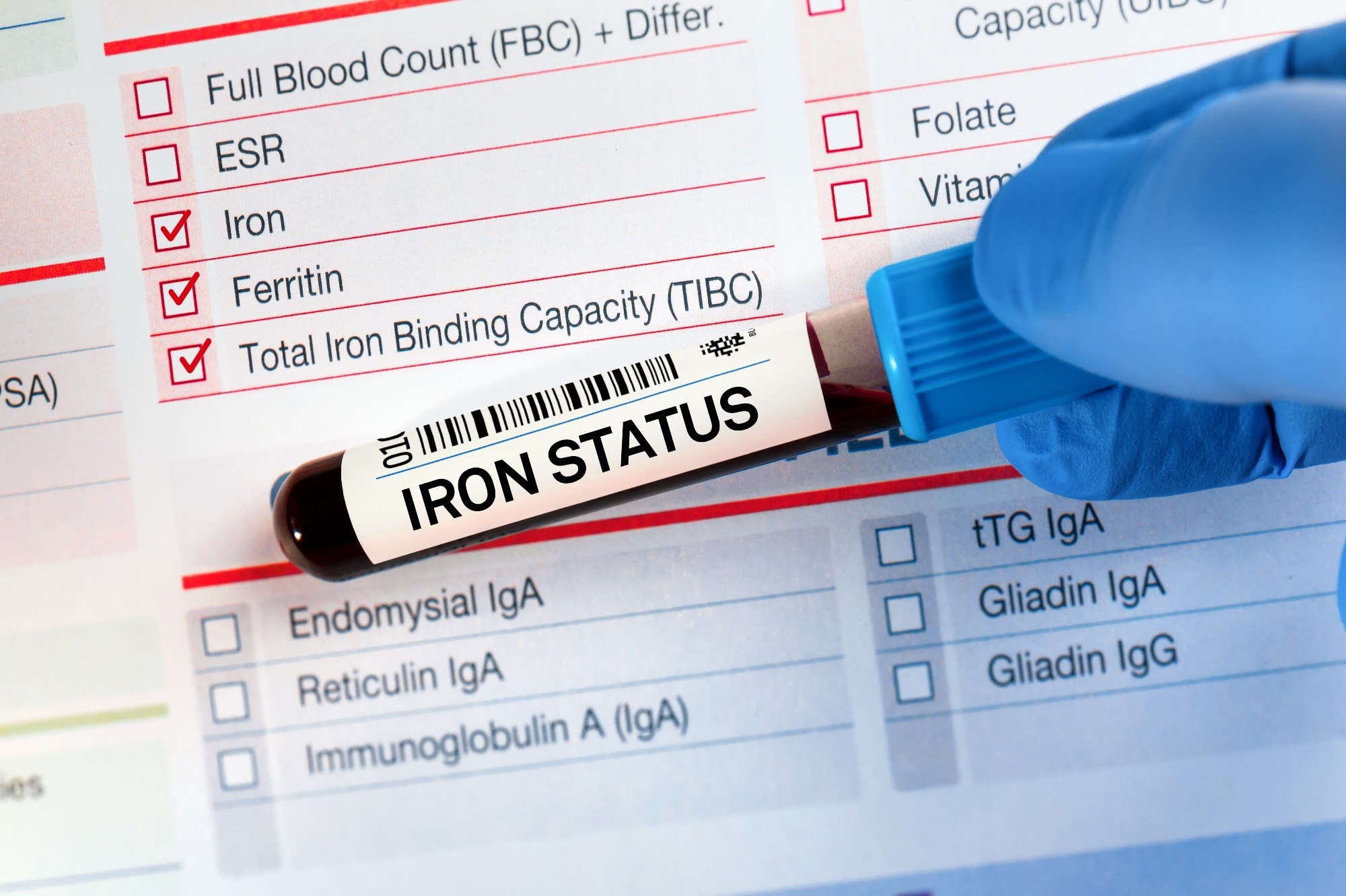 Study: Prevalence of Iron Deficiency Using 3 Definitions Among Women in the US and Canada. Image Credit: angellodeco/Shutterstock.com