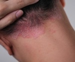New study links psoriasis severity to skin microbiome dysbiosis
