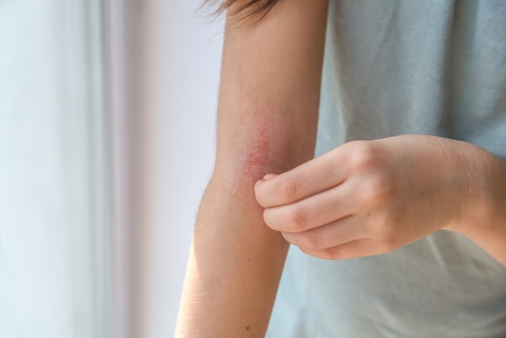 Study: Long-Term Use of Oral Corticosteroids and Safety Outcomes for Patients With Atopic Dermatitis. Image Credit: Evgeniia Primavera/Shutterstock.com