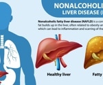 Higher soft drink consumption linked to increased risk of liver disease