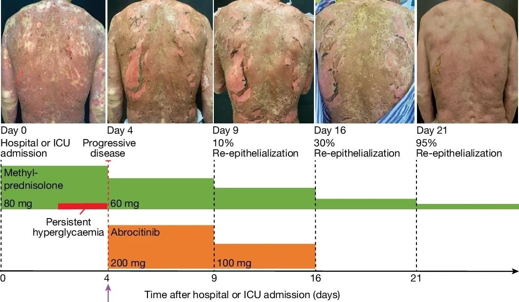 Disease course in a patient with TEN (SCORTEN 4) associated with cancer treatment. Disease progression was observed during high-dose intravenous methylprednisolone treatment and the patient developed persistent hyperglycaemia. JAK1i rescue therapy with abrocitinib was initiated on day 4, resulting in visible cessation of progression within 48 h and initial re-epithelialization within 4 days. Top, photographs of the back of the patient, showing the degree of re-epithelialization at the indicated timepoints after hospital admission. Bottom, Treatment schedule. Arrow marks start of abrocitinib treatment. Study: Spatial proteomics identifies JAKi as treatment for a lethal skin disease