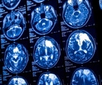 Camouflage detection boosts neural networks for brain tumor diagnosis