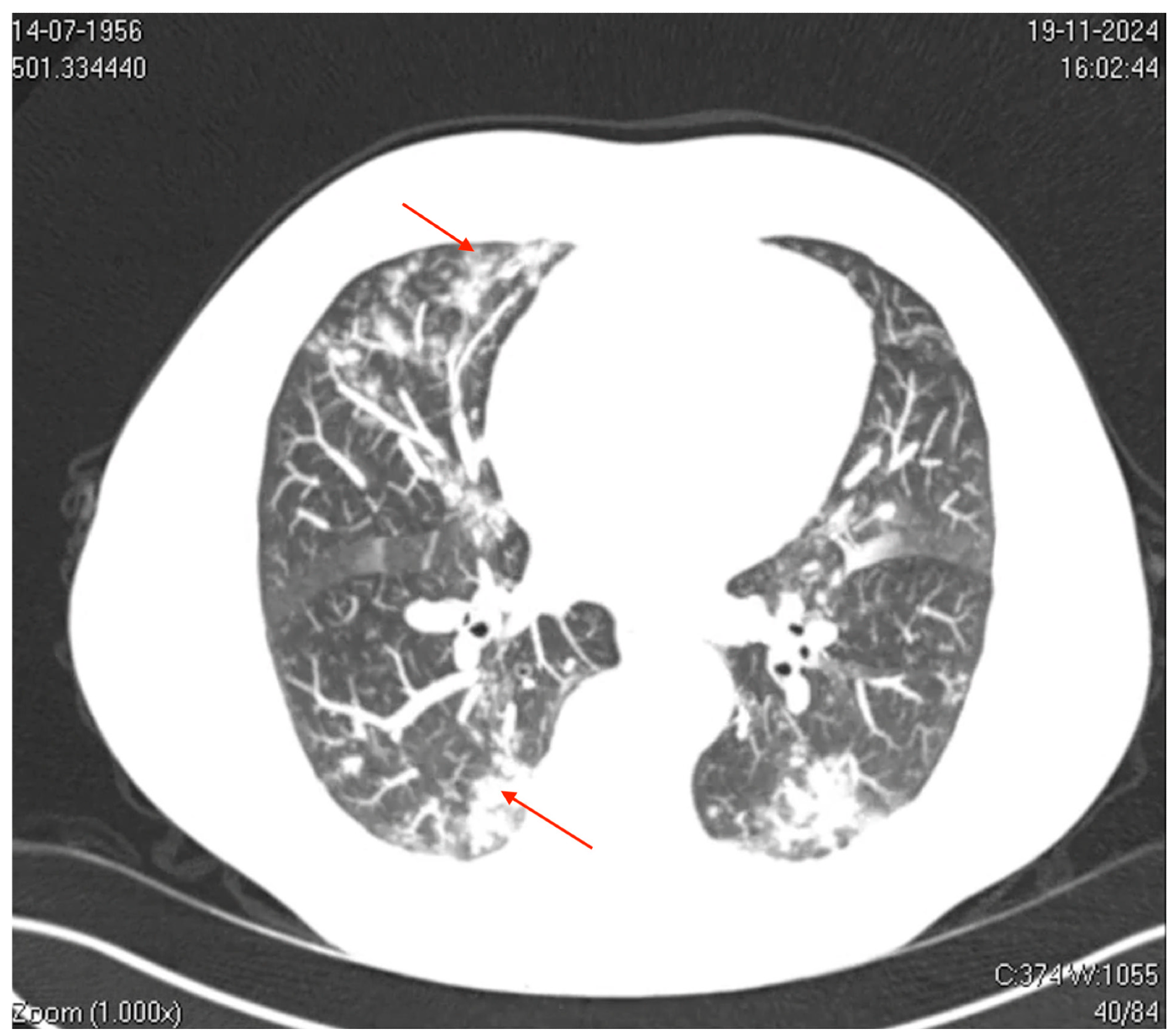 Axial computed tomography (CT) image of the thorax. The image shows bilateral ground-glass opacities with a reticular pattern interspersed with focal areas of consolidation and peripheral bronchiolar filling. The red arrows highlight specific areas of consolidation surrounded by ground-glass opacities, which are more prominent in the peripheral and lower lung regions. These findings suggest a diffuse inflammatory or infectious process involving the pulmonary interstitial and peripheral airways (acinus and bronchioles), which is consistent with viral pneumonia.