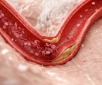 Researchers identify a natural defense against blood vessel inflammation and atherosclerosis