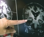 Autism risk genes linked to white matter changes at birth, shaping early brain development