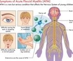 Gaps in surveillance leave European children at risk of acute flaccid myelitis