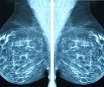 AI spots future breast cancer risk in mammograms years before diagnosis
