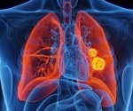 IL-6 and CRP offer limited boost for predicting infections after lung cancer surgery