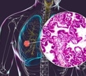 EAGLE model predicts key lung cancer mutations from routine biopsy